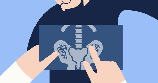 bone density test