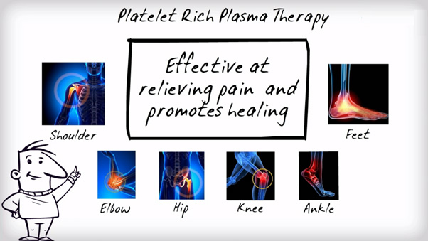 platelet rich plasma